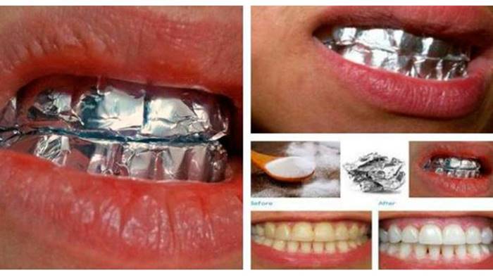 This Is What Happens When You Wrap Your Teeth In Aluminum Foil For 1 Hour I Creative Ideas